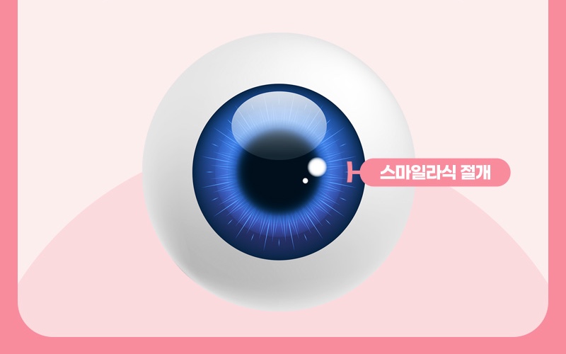 스마일라식 최소 절개를 표시한 안구 그림